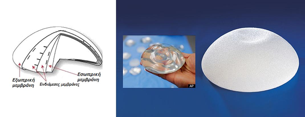 Ενθέματα μαστών