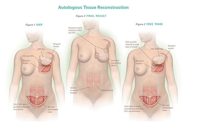 Αυξητική Στήθους με Αυτόλογους Ιστούς