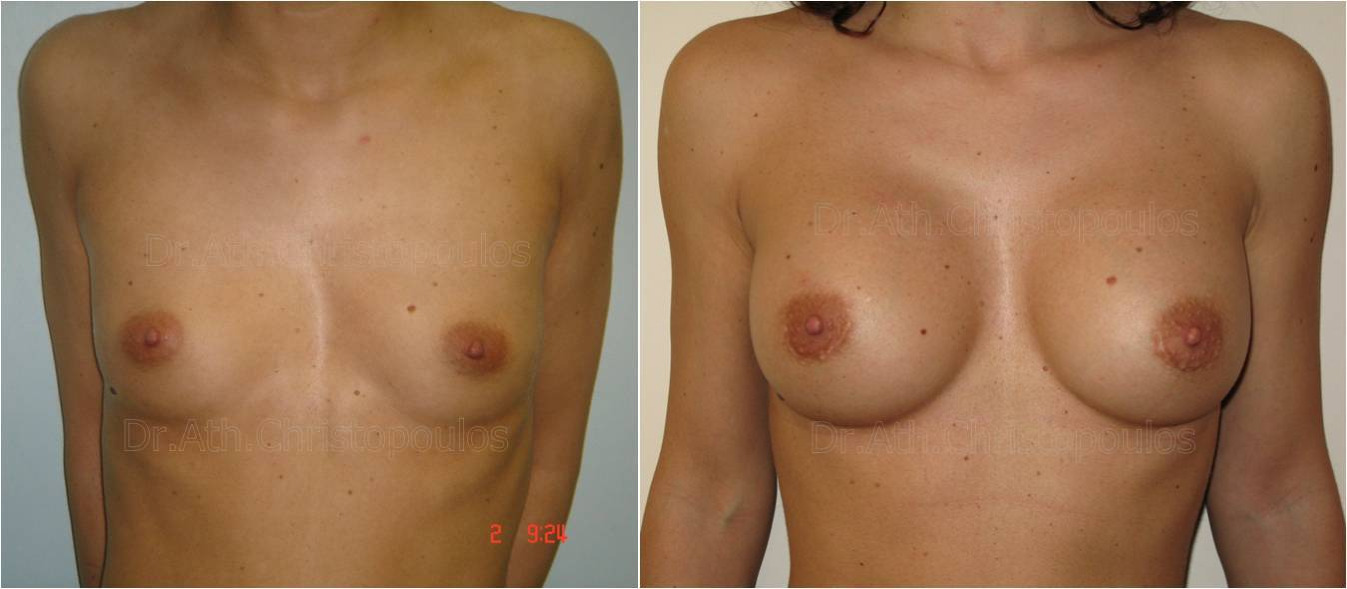 Επεμβάσεις Πριν - Μετά