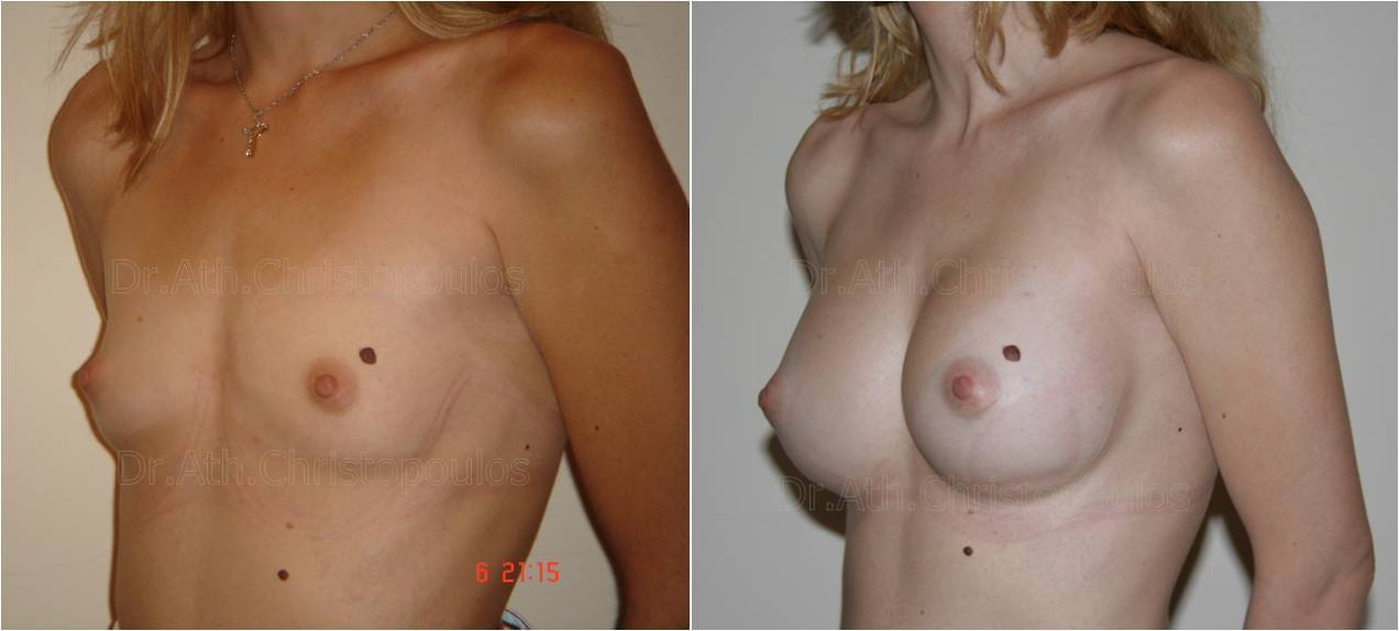 Επεμβάσεις Πριν - Μετά