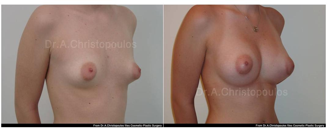 Επεμβάσεις Πριν - Μετά