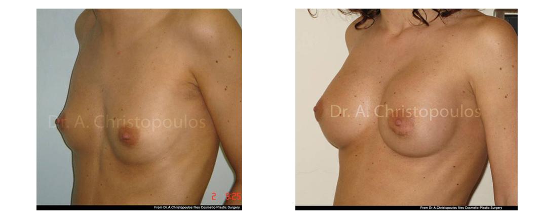 Επεμβάσεις Πριν - Μετά