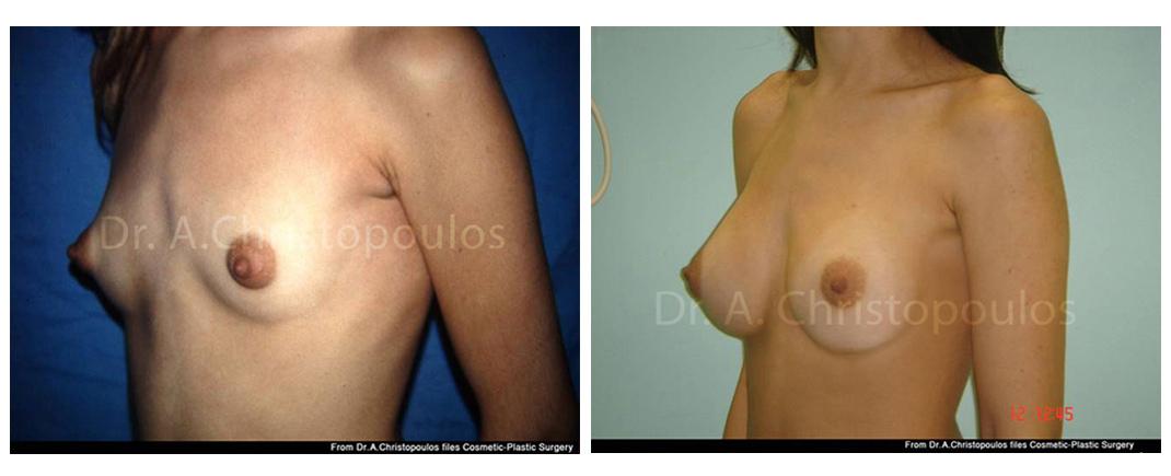 Επεμβάσεις Πριν - Μετά