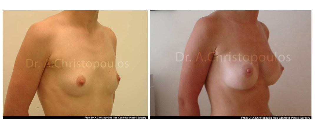 Επεμβάσεις Πριν - Μετά