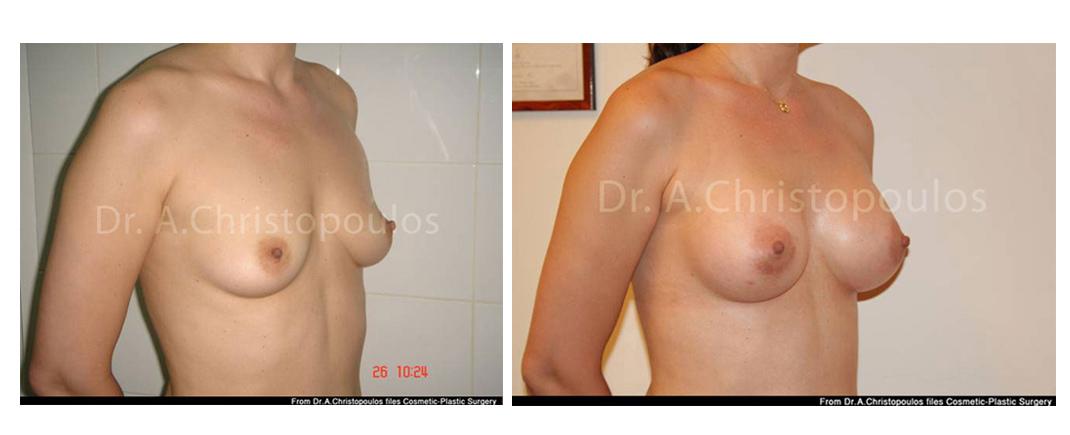 Επεμβάσεις Πριν - Μετά