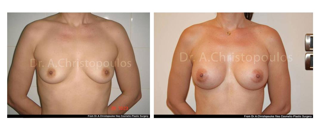 Επεμβάσεις Πριν - Μετά