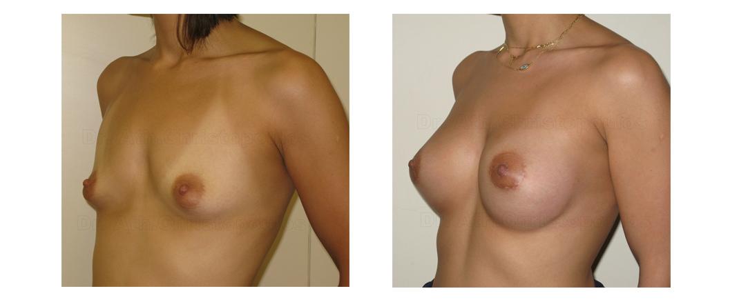 Επεμβάσεις Πριν - Μετά