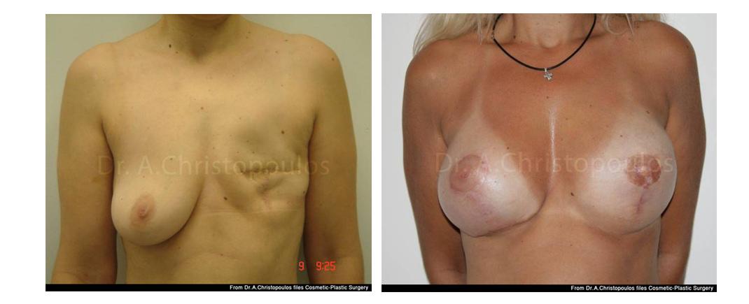 Επεμβάσεις Πριν - Μετά