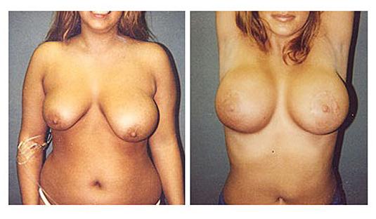 Ανισομαστία