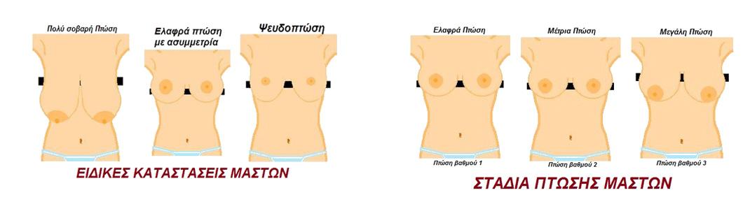 Ανόρθωση στήθους και Αυξητική