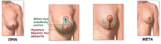 Ανόρθωση στήθους και Αυξητική