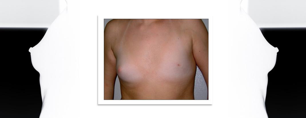 Απλασία Θηλής