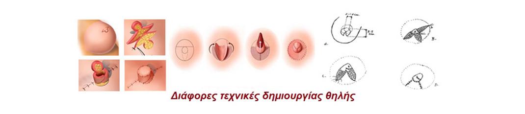 Απλασία Θηλής