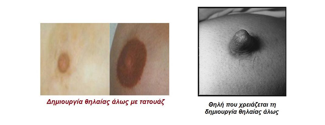 Απλασία Θηλής