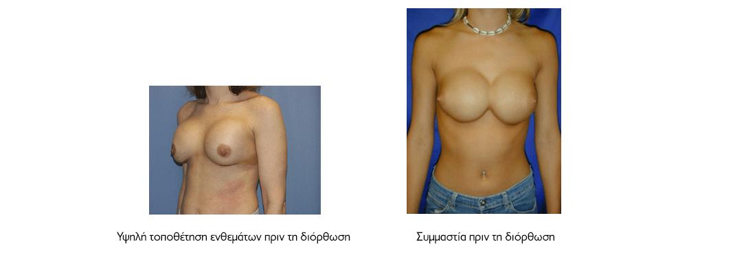Διόρθωση Mal-Positioning