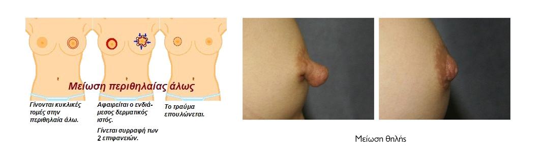 Μέιωση Θηλής